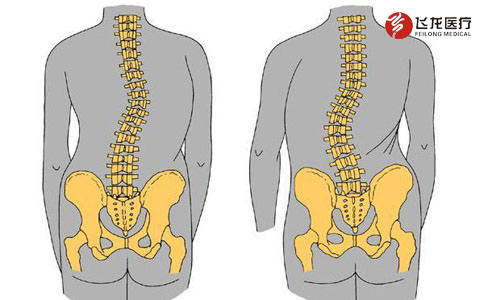 脊柱侧弯