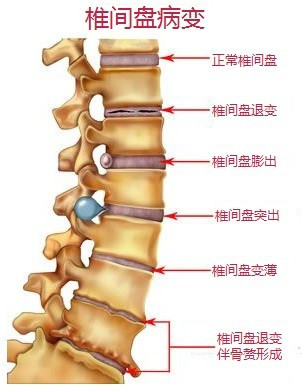 椎间盘病变